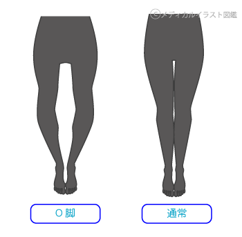 O脚 中央林間の整体院 腰痛 肩こりでお悩みならまごころ施術院